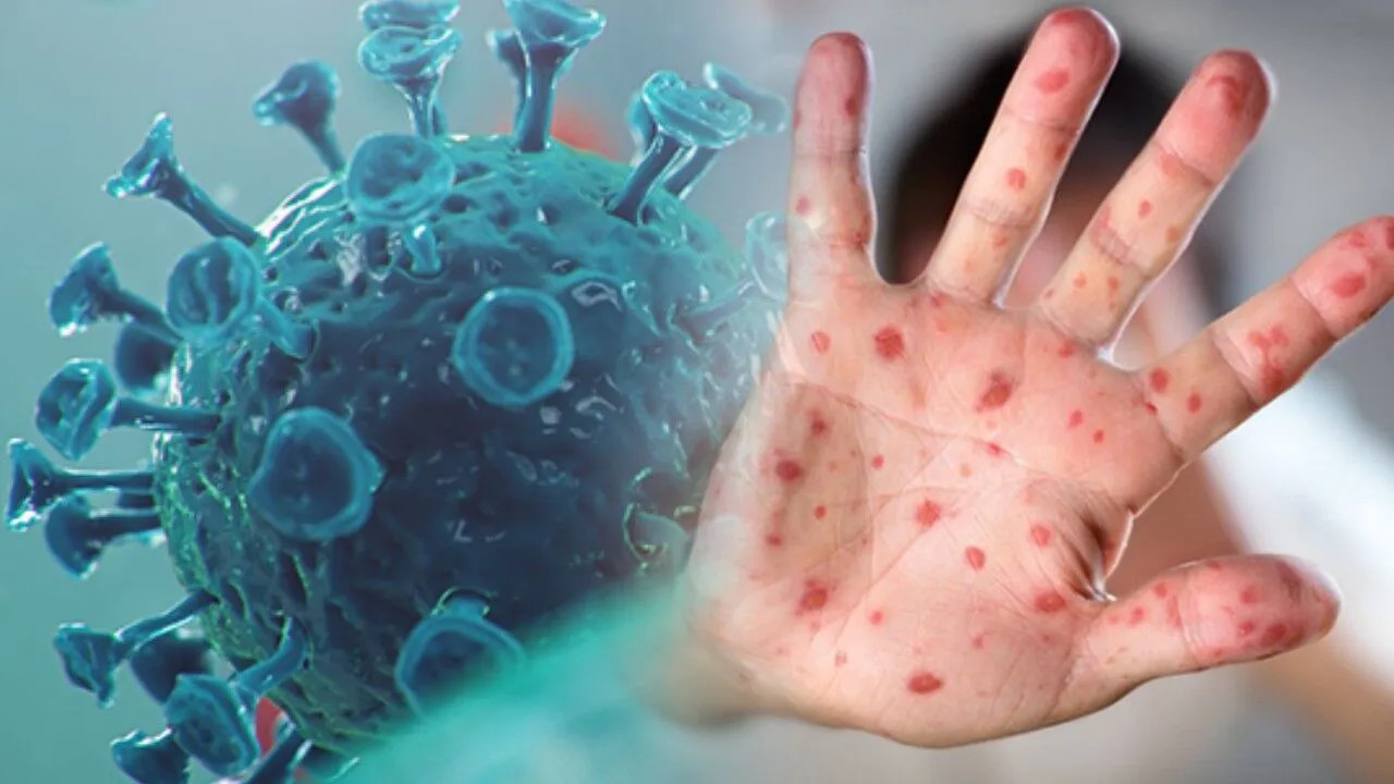 Küresel tehdit: Maymun Çiçeği salgını kapımızda