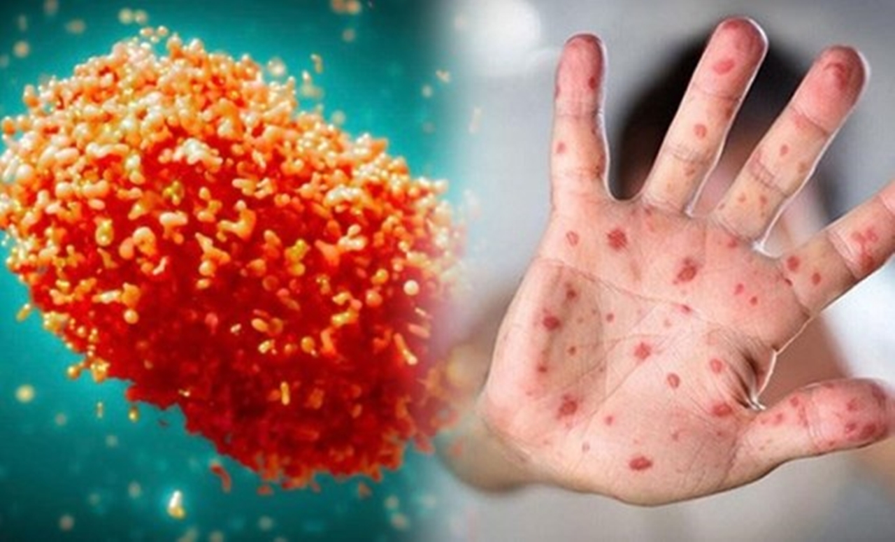 Küresel tehdit: Maymun Çiçeği salgını kapımızda