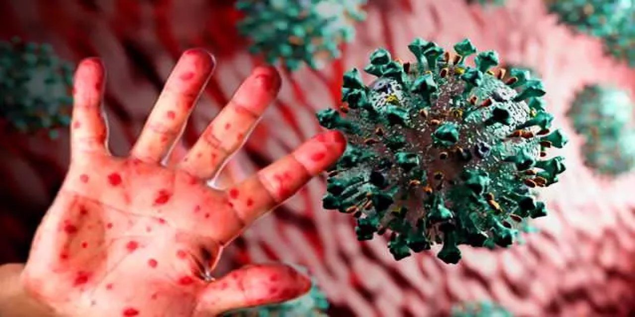 Küresel tehdit: Maymun Çiçeği salgını kapımızda