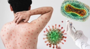 Küresel tehdit: Maymun Çiçeği salgını kapımızda