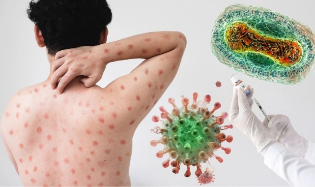 Küresel tehdit: Maymun Çiçeği salgını kapımızda