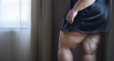 Kadınların Gizli Düşmanı: Lipödem