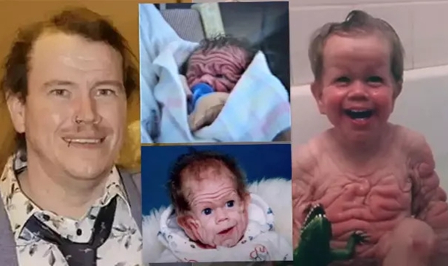 Tomm Tennent: Tıp d&uuml;nyasını şaşkına &ccedil;eviren olağan&uuml;st&uuml; bir vaka - D&Uuml;NYA -  100. Yıl Haber